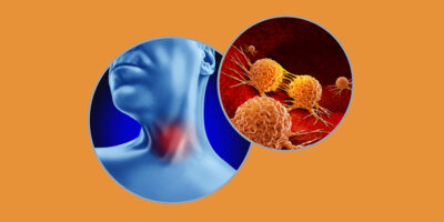 Throat Cancer as abnormal cell growth as aryngeal or pharyngeal and HPV related cancers as a patient with a tumor in the neck with 3D illustration elements